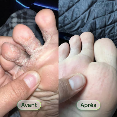 Savon Purifiant Antifongique