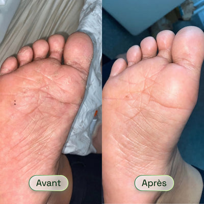 Savon Purifiant Antifongique