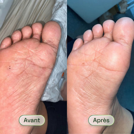Savon Purifiant Antifongique